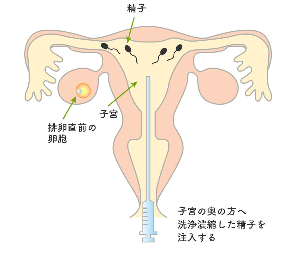 人工授精