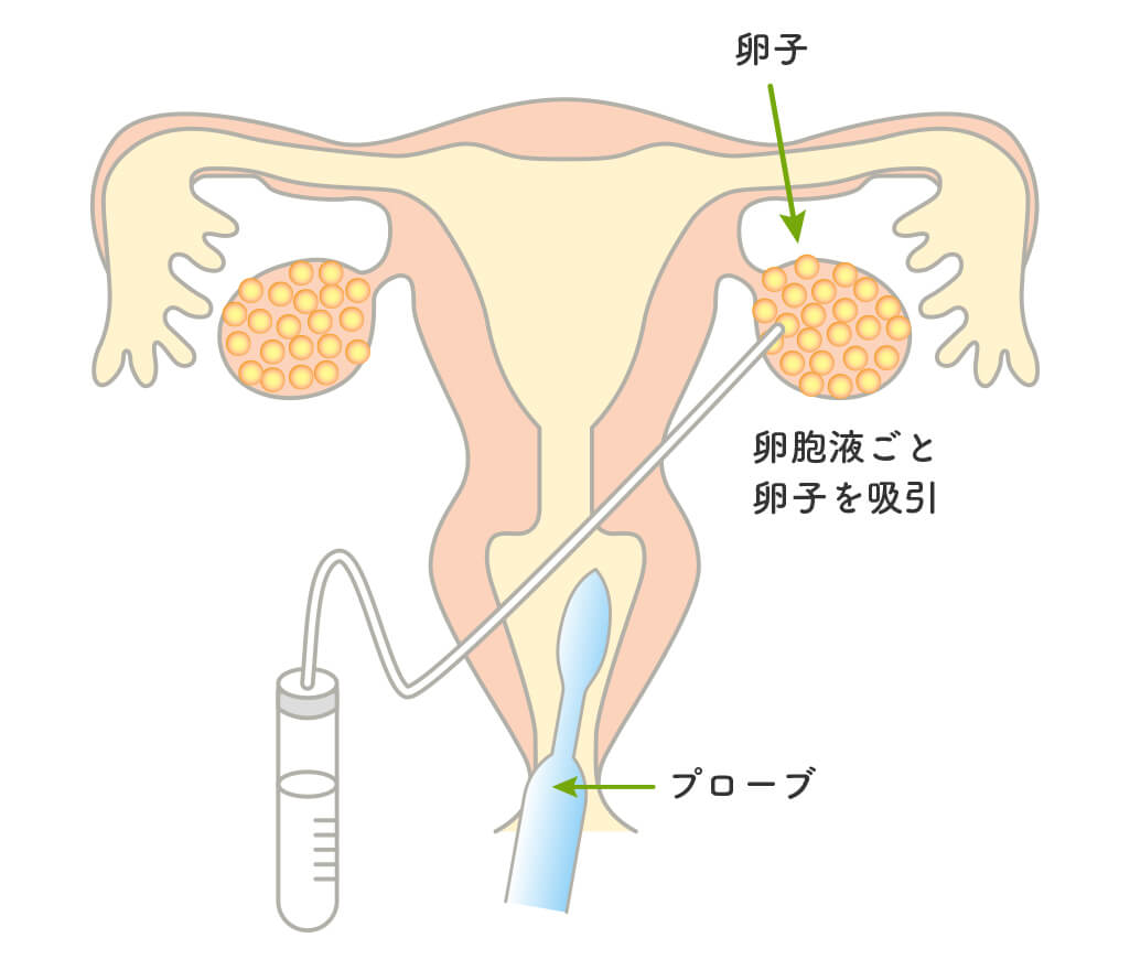 採卵