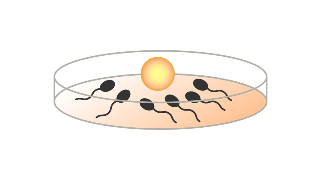 体外受精(IVF)